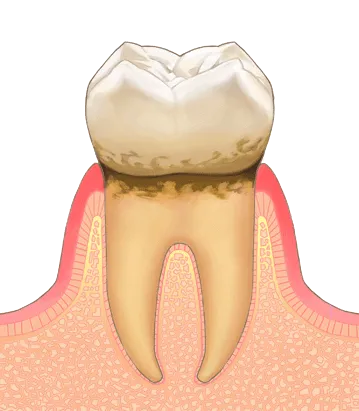 歯周病とは